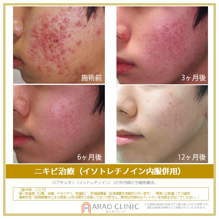 ロアキュタン イソトレチノイン によるニキビ治療 横浜市青葉区の美容皮膚科 形成外科あらおクリニック
