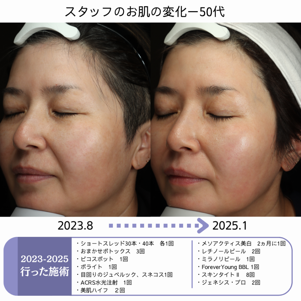 50代スタッフのお肌変化