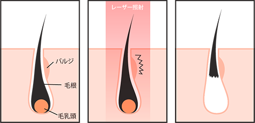 医療レーザー脱毛の仕組み