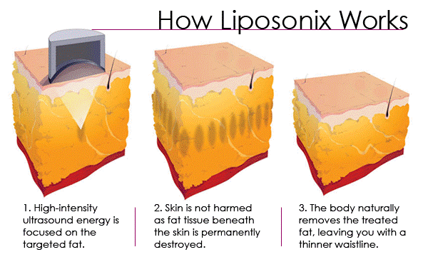 痩身マシン ライポソニックス liposonixの原理