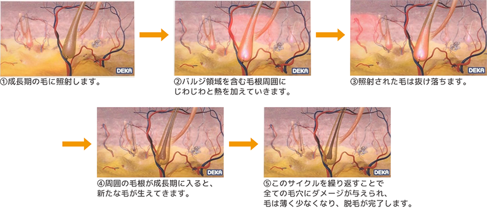 単発式と蓄熱式脱毛の違い