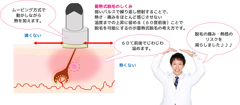 蓄熱式脱毛
