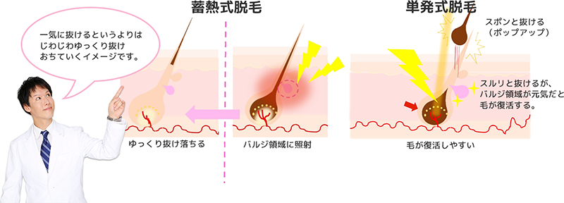 単発式脱毛