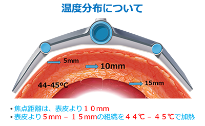 痩身マシン vanquish 温度