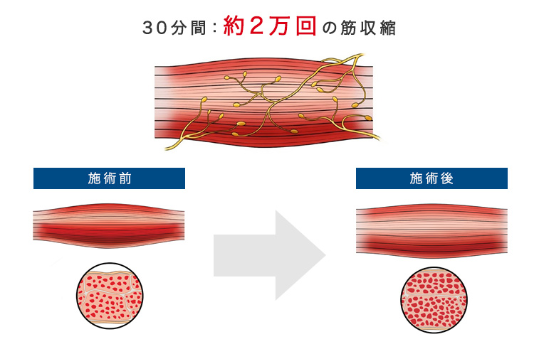 30分間：約2万回の筋収縮