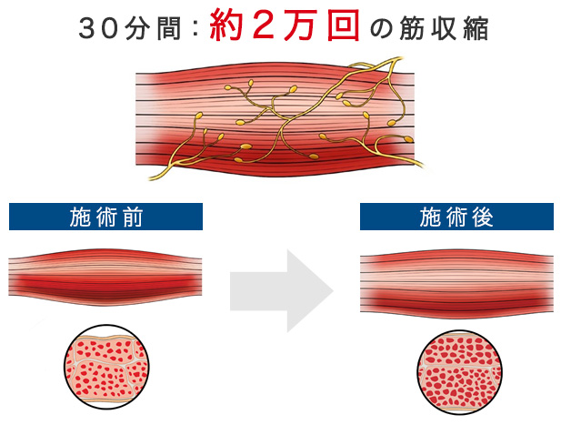 30分間：約2万回の筋収縮